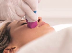 Thermage® FLX, pour ralentir les effets du temps