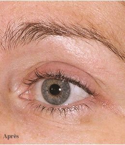 Thermage® FLX, pour ralentir les effets du temps