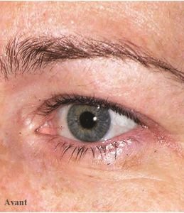 Thermage® FLX, pour ralentir les effets du temps